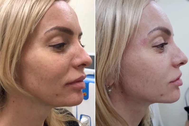 Bezymyannyj.webp SMAS-лифтинг: фото до и после