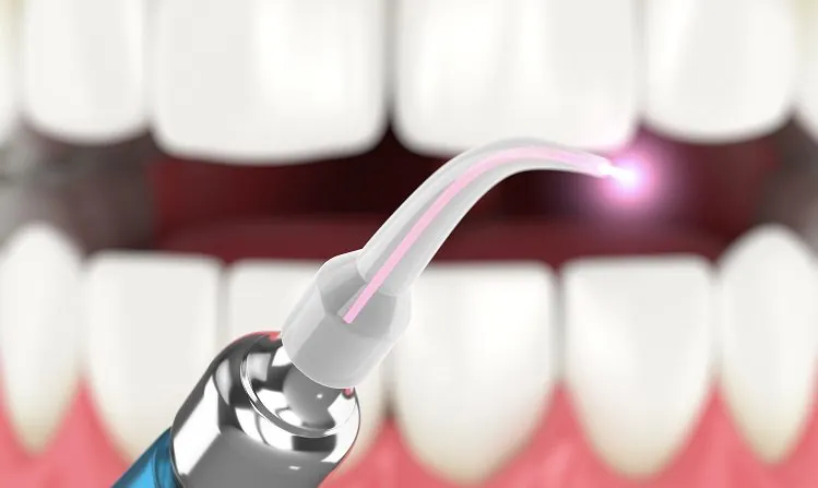 Everything-you-need-to-Know-about-laser-dentistry-e1603972031862.webp Стоматологический лазер